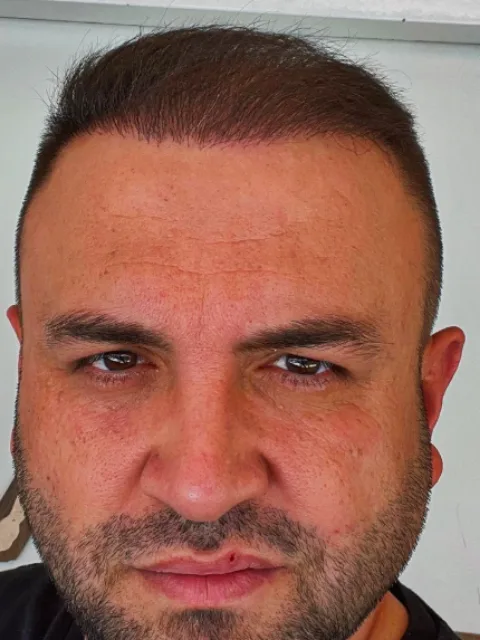 Saç ekimi sonrası, vaka 1