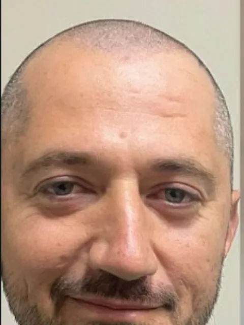 Saç ekimi öncesi, vaka 5