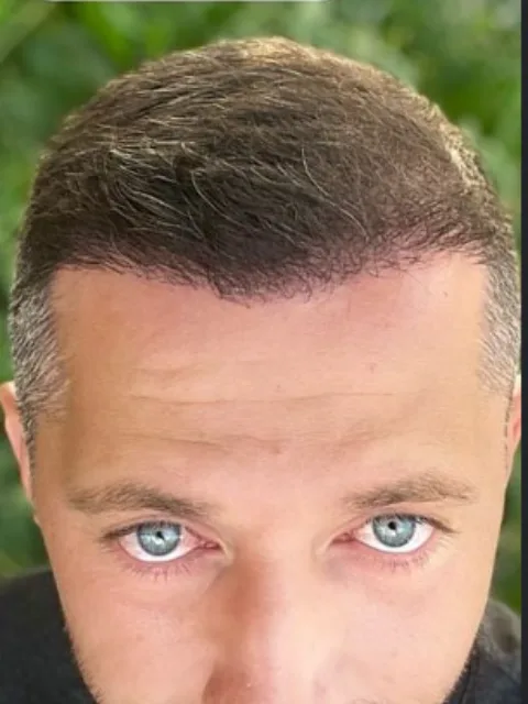Saç ekimi sonrası, vaka 5